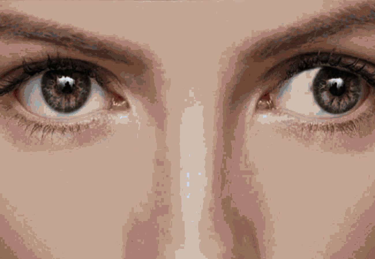 estrabismo divergente.jpg